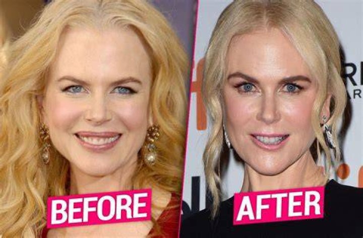 Nicole Kidman Cosmetic Surgery: Exploring the Transformations of a Hollywood Icon