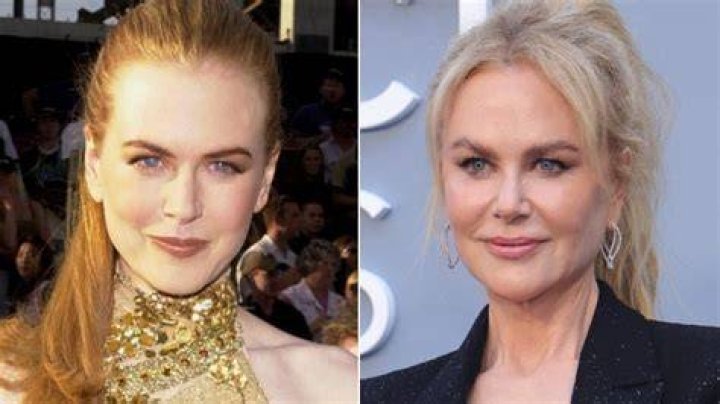 Nicole Kidman Plastic Surgery: A Comprehensive Analysis of Her Transformation Over the Years